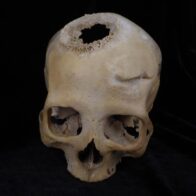 Un joven de 30 años del Antiguo Egipto, primer paciente operado de cáncer hace 4.500 años