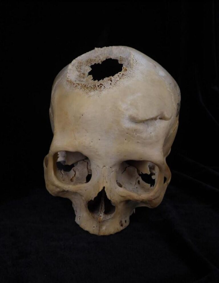 Un joven de 30 años del Antiguo Egipto, primer paciente operado de cáncer hace 4.500 años