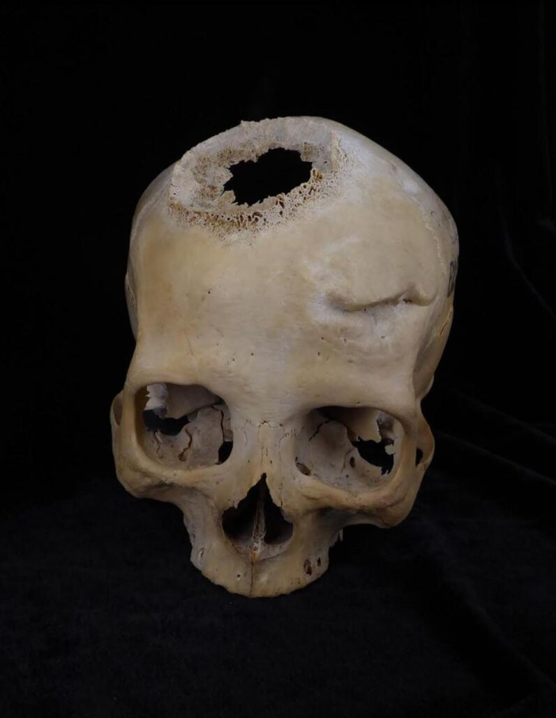 Un joven de 30 años del Antiguo Egipto, primer paciente operado de cáncer hace 4.500 años