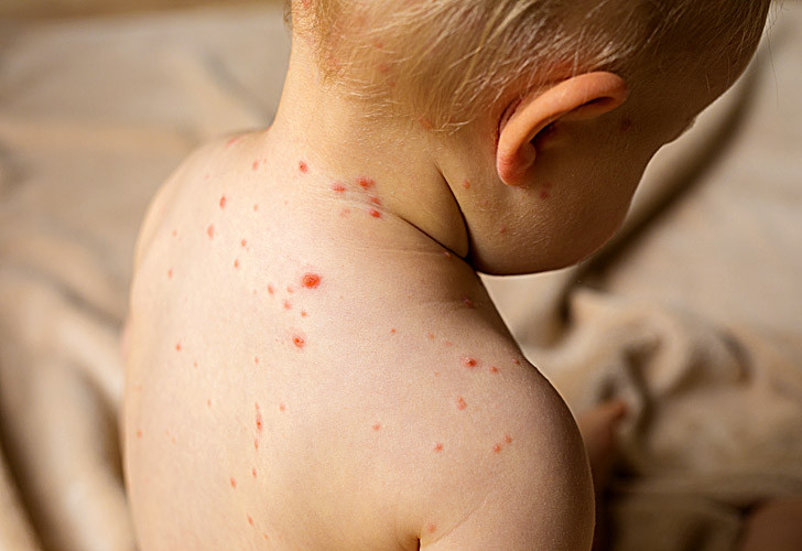Bolivia declara la alerta epidemiológica tras un caso confirmado de sarampión