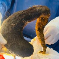 Extraen una bola gigante de cabello del estómago de una joven de 24 años en Ecuador