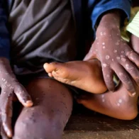 Casi 21.500 casos de mpox