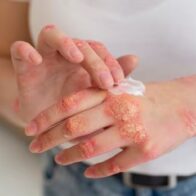 Los científicos alertan ante la amenaza mundial de las enfermedades causadas por hongos