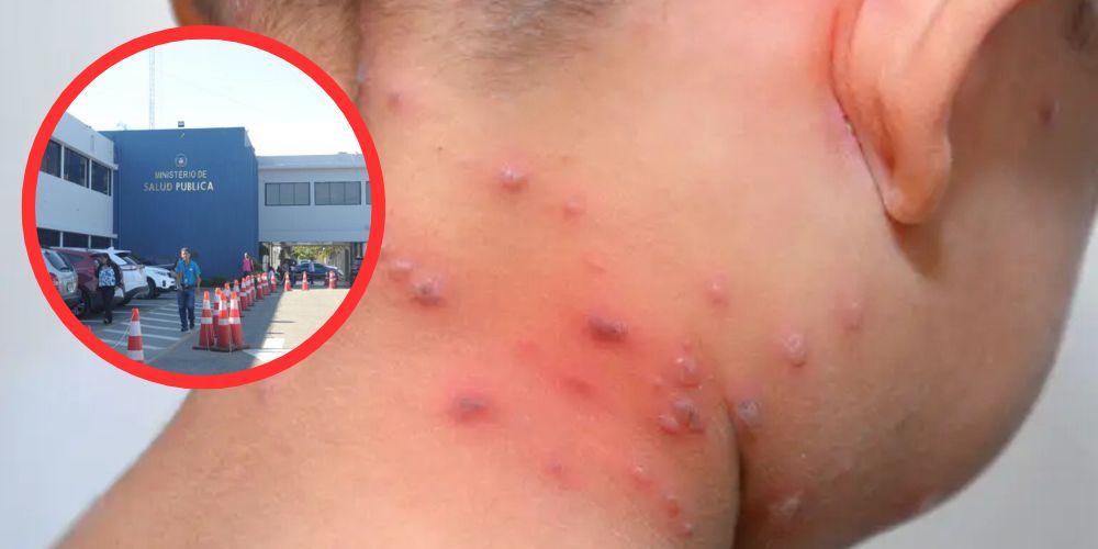 ¡Atención! Salud Pública notifica un brote varicela en escuela SDE