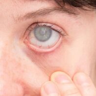 Cataratas: una condición frecuente con una solución efectiva