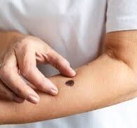 Melanoma