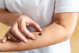 Melanoma