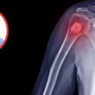 Aumentan tumores a nivel óseo en pacientes luego del Covid-19, afirman especialistas