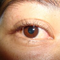 Las enfermedades de la retina: un llamado a la prevención para proteger la visión