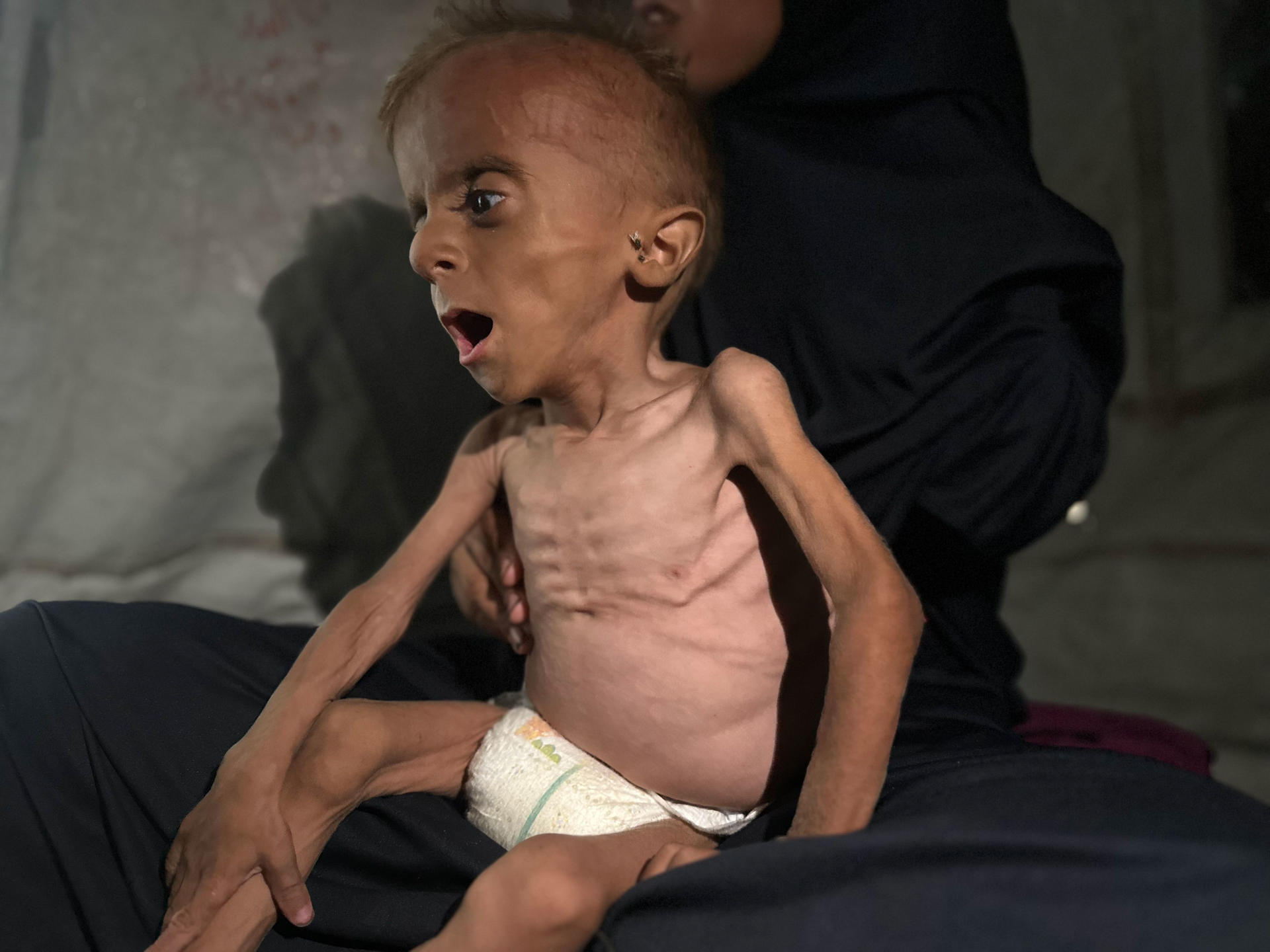 Seis nuevos gazatíes mueren por desnutrición, dos de ellos niños