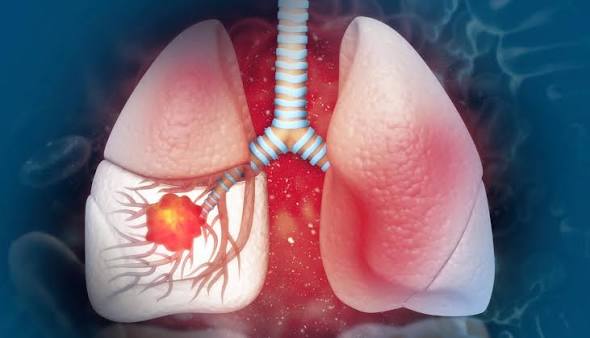 Pulmones saludables: hábitos que ayudan a prevenir enfermedades respiratorias