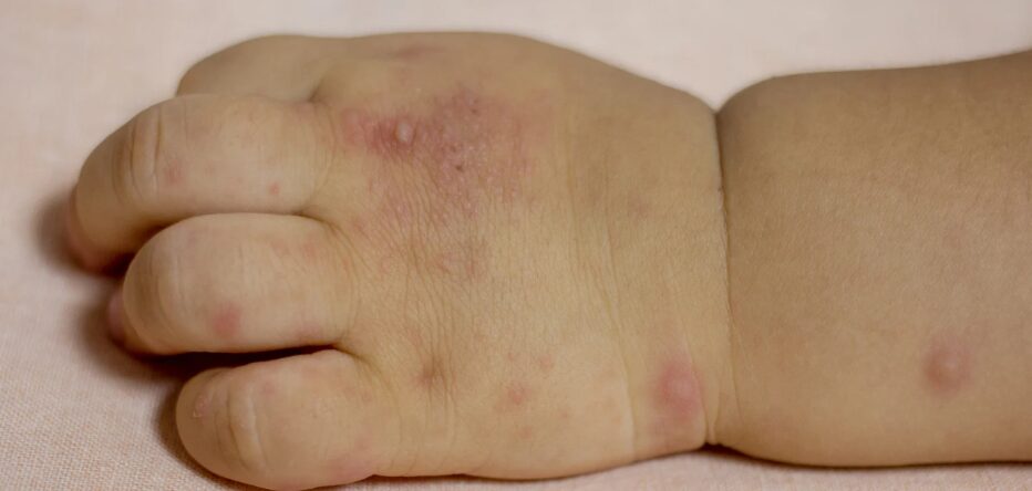 Mano-boca-pie: la enfermedad infantil que requiere atención inmediata en niños menores de cinco años