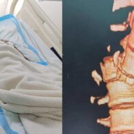 Familiares piden ayuda para adolescente de 16 años accidentada en San Pedro de Macorís