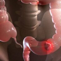 El cáncer colorrectal se protege de la inmunoterapia