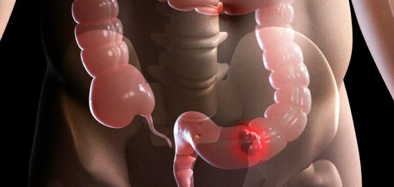 El cáncer colorrectal se protege de la inmunoterapia