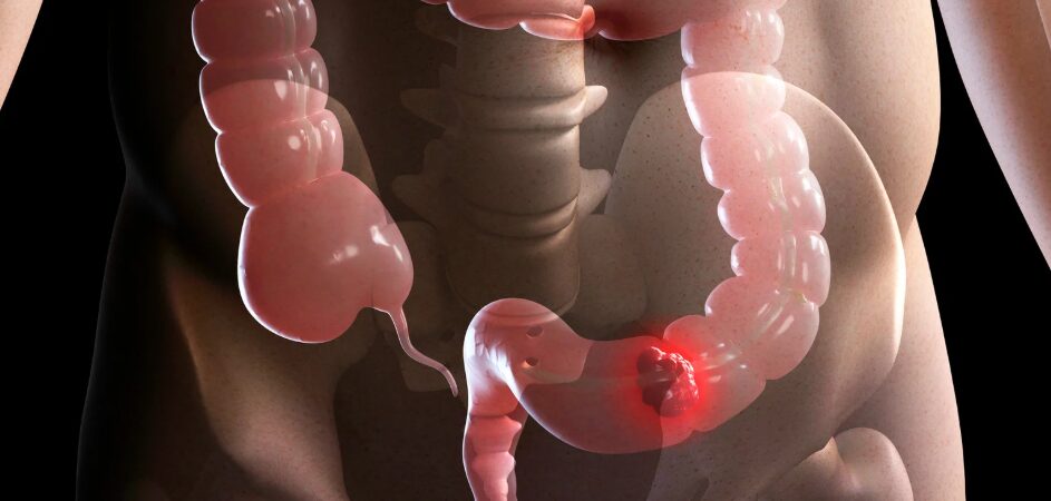El cáncer colorrectal se protege de la inmunoterapia