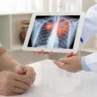 El cáncer de pulmón es la neoplasia más letal en el mundo y necesita “detección temprana”