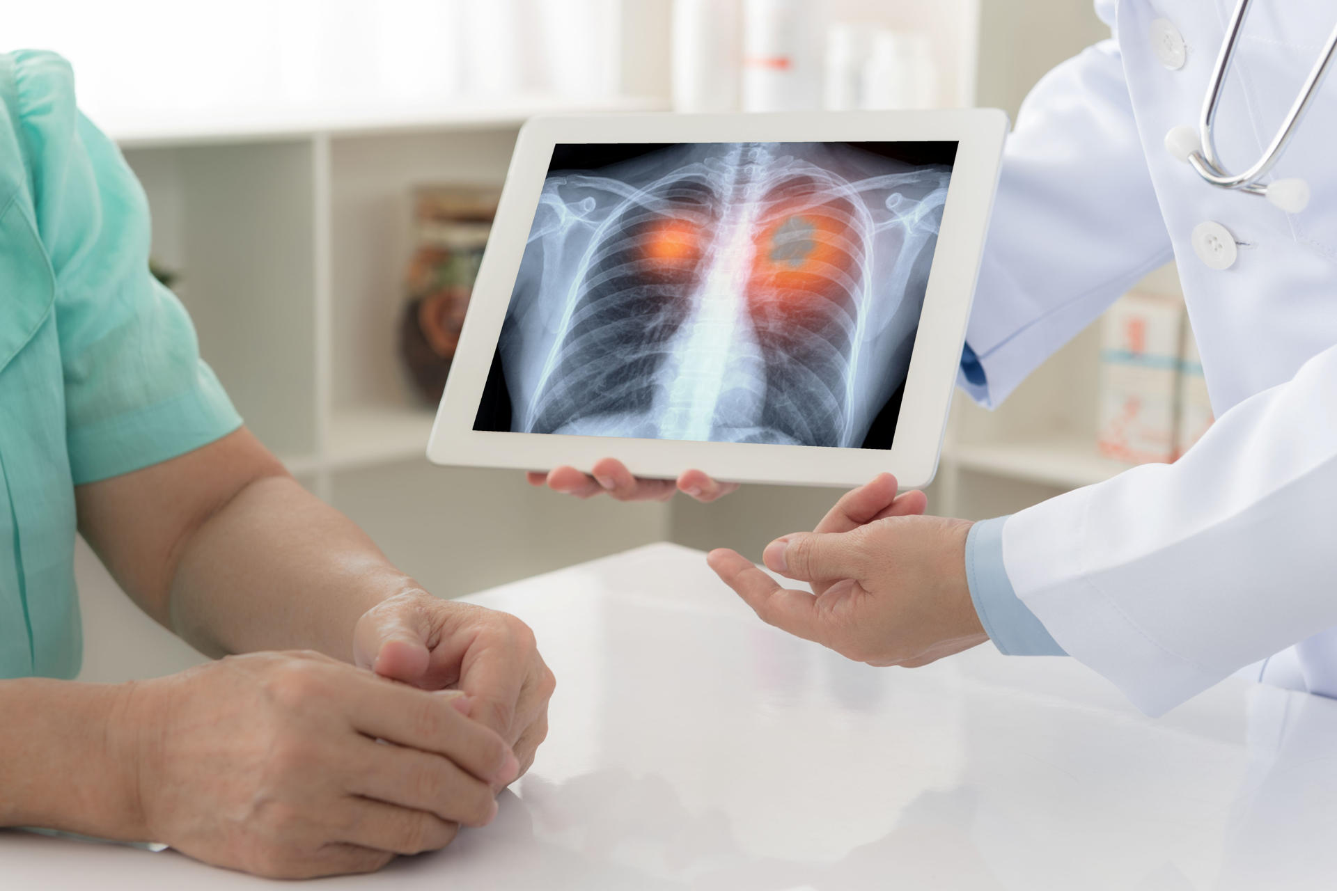 El cáncer de pulmón es la neoplasia más letal en el mundo y necesita “detección temprana”