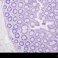 Una vacuna demuestra eficacia para prevenir el cáncer de colon en un ensayo clínico