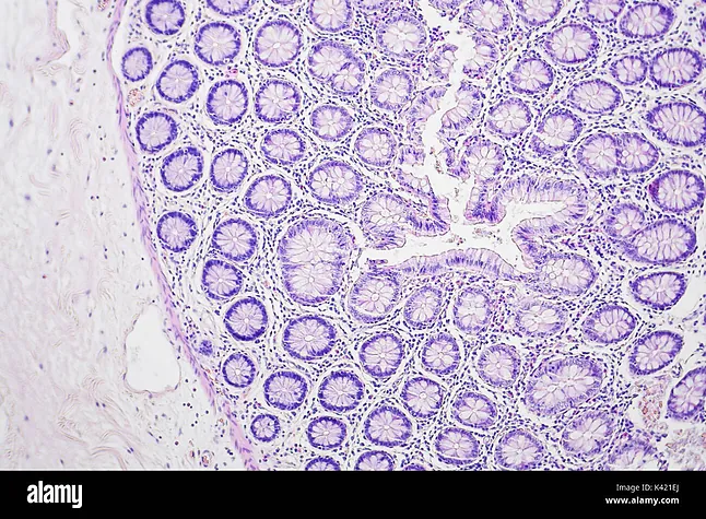 Una vacuna demuestra eficacia para prevenir el cáncer de colon en un ensayo clínico