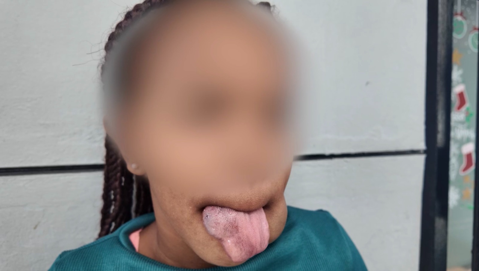 Madre pide ayuda para costear cirugía de su hija por malformación vascular que el seguro no cubre