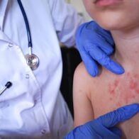 El sarampión supera los 2.500 casos y 38 brotes en Estados Unidos, la mayor cifra en 35 años
