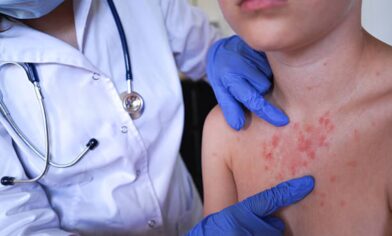 El sarampión supera los 2.500 casos y 38 brotes en Estados Unidos, la mayor cifra en 35 años