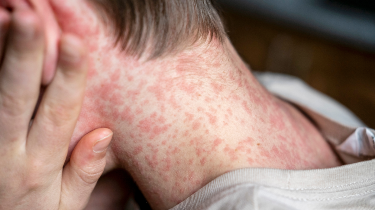 Florida alerta de brotes de sarampión en universidades ante récord del virus en EE.UU.