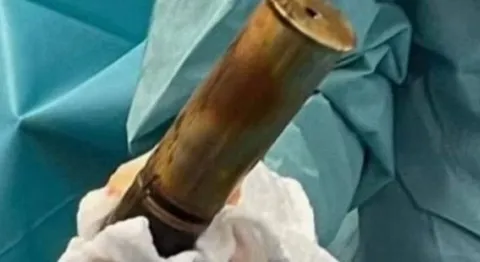 Extraen un obús de la Primera Guerra Mundial del recto de un joven en un hospital del sur de Francia