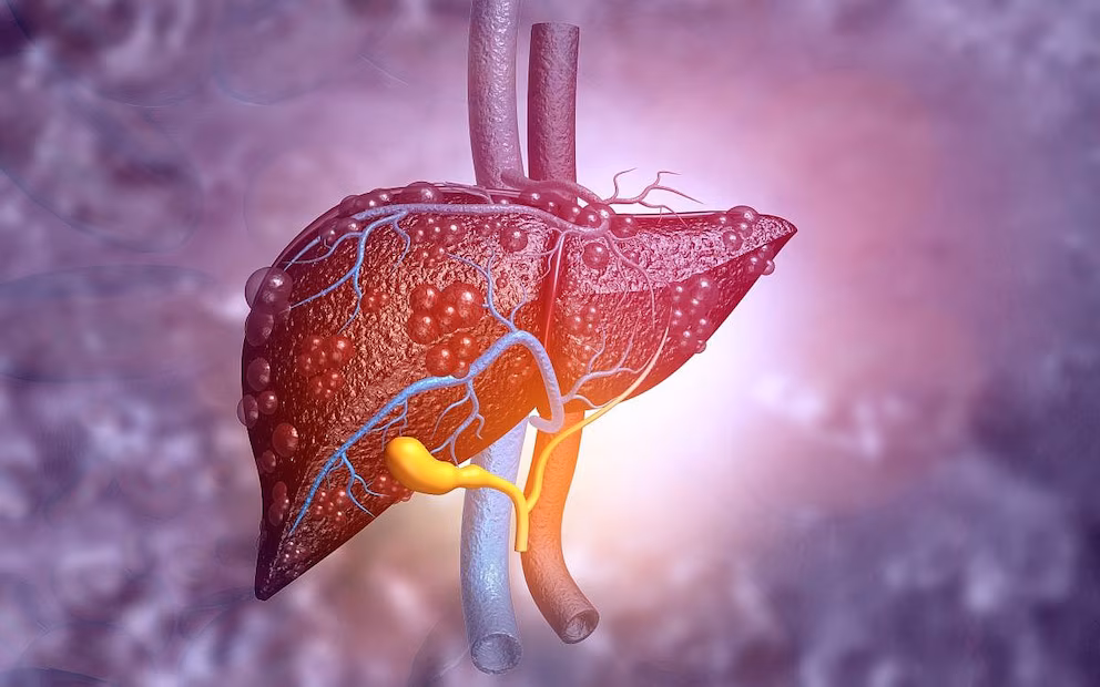 Análisis de sangre revela enfermedad hepática relacionada con el alcohol