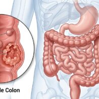 Día Mundial Contra el Cáncer de Colon