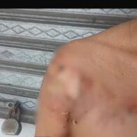 Mujer resulta con graves quemaduras tras ser atacada con aceite caliente por deuda de RD$1,000 en Moca