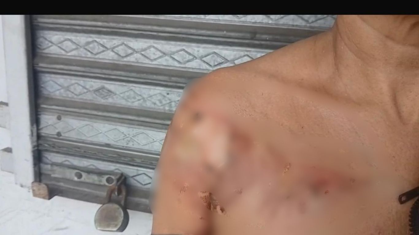 Mujer resulta con graves quemaduras tras ser atacada con aceite caliente por deuda de RD$1,000 en Moca