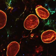 Descubren una proteína sanguínea que podría frenar el avance del cáncer de páncreas