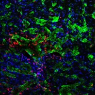 Investigadores españoles descubren cómo las células tumorales alteran el cerebro y logran diseminar el cáncer