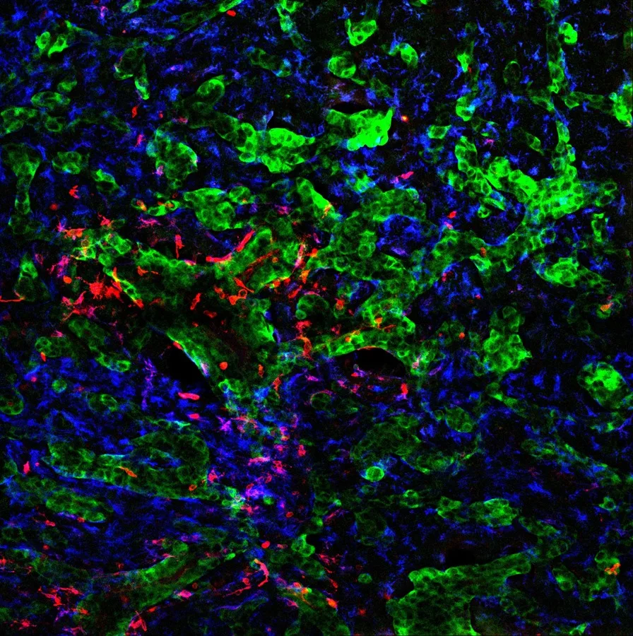 Investigadores españoles descubren cómo las células tumorales alteran el cerebro y logran diseminar el cáncer