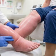 Día Internacional del Linfedema