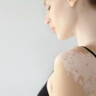El vitiligo no es igual en todos: un estudio descubrió diferencias genéticas según la edad de inicio