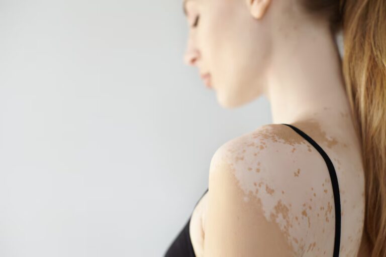 El vitiligo no es igual en todos: un estudio descubrió diferencias genéticas según la edad de inicio
