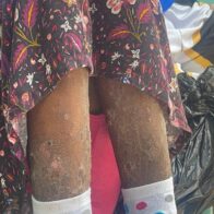 Denuncian abandono médico: niña enferma con extraña enfermedad espera por horas sin atención en hospital infantil de Santiago