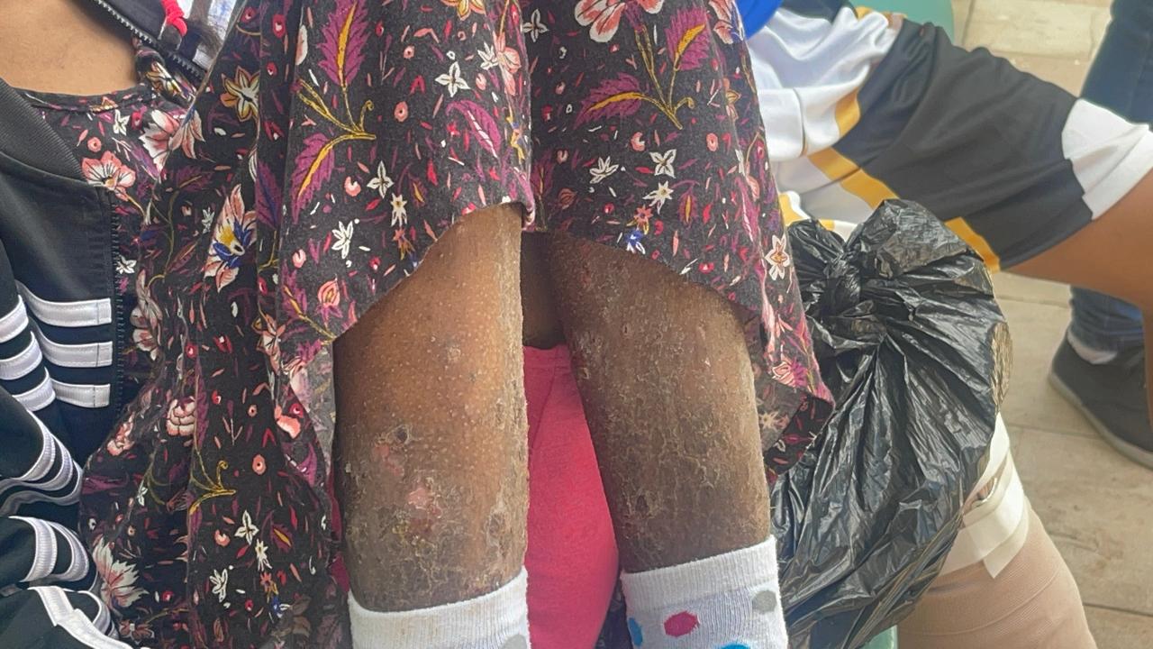 Denuncian abandono médico: niña enferma con extraña enfermedad espera por horas sin atención en hospital infantil de Santiago