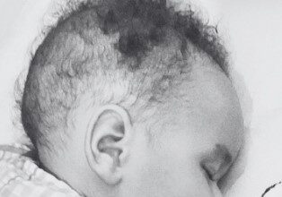 Muere bebé con atrofia muscular espinal que esperaba acceso a medicamento