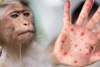 Costa Rica detecta dos casos de viruela del mono y activa protocolos de vigilancia