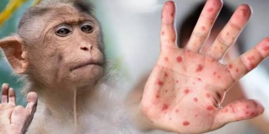 Costa Rica detecta dos casos de viruela del mono y activa protocolos de vigilancia