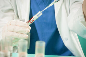 Uruguay registró 739 diagnósticos de infección por VIH en 2025, 93 menos que en 2024