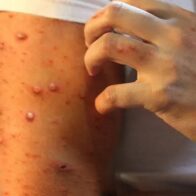 Alerta en San Cristóbal: Salud Pública confirma casos de viruela símica en destacamento policial
