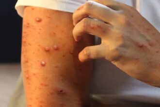 Alerta en San Cristóbal: Salud Pública confirma casos de viruela símica en destacamento policial
