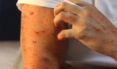 Alerta en San Cristóbal: Salud Pública confirma casos de viruela símica en destacamento policial