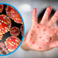 Viruela símica: qué es, cuáles son sus síntomas y cómo puede transmitirse