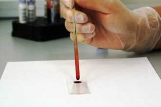 Estudio revela análisis de sangre que mejora la detección del cáncer de próstata agresivo